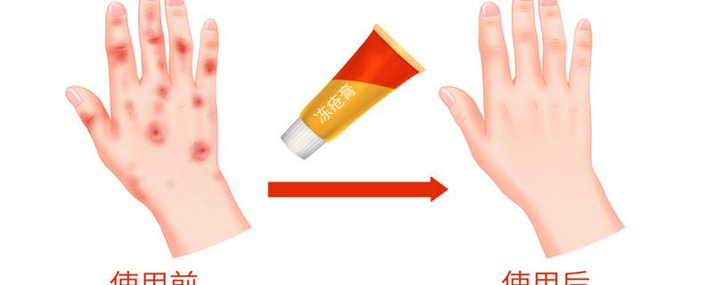 冻疮不痒不痛怎么回事 冻疮什么样是快要好了