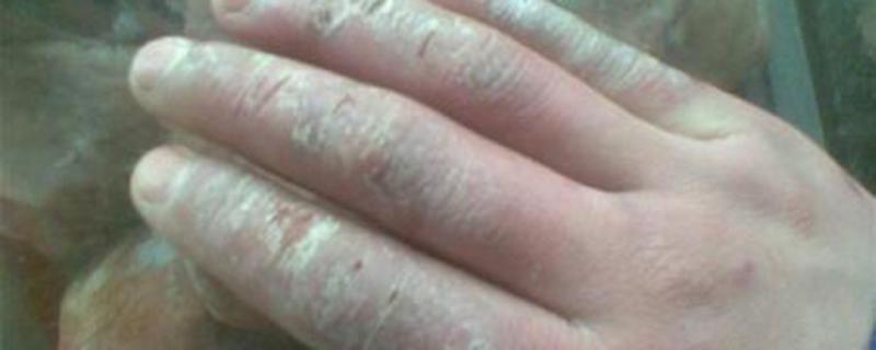 手长冻疮了怎么治最有效 手长冻疮很痒怎么办