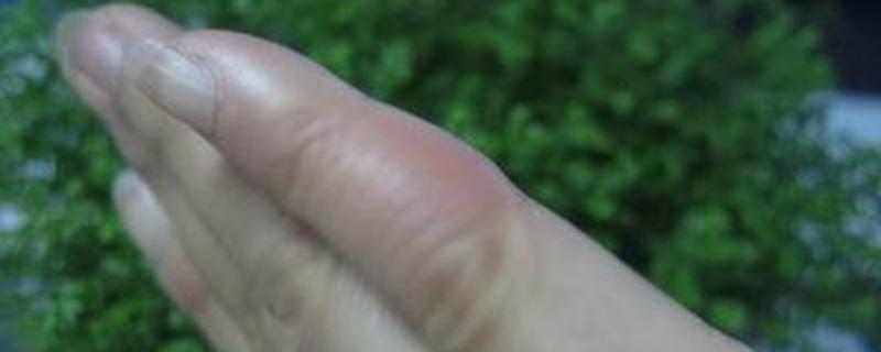 冻疮是因为湿气重吗 什么人容易长冻疮