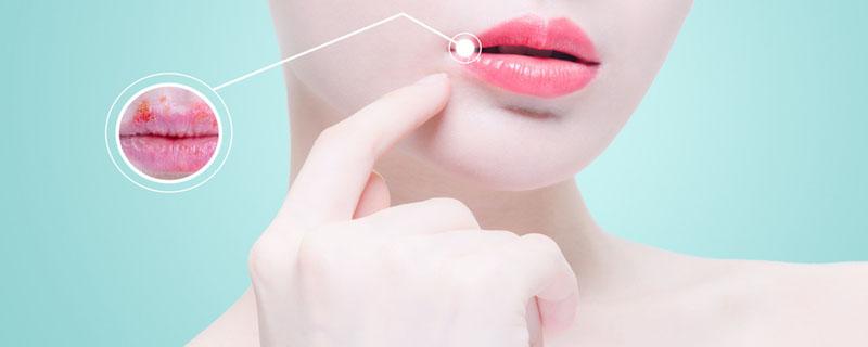 嘴巴上火没有唇膏怎么办 嘴唇干裂怎么快速消除