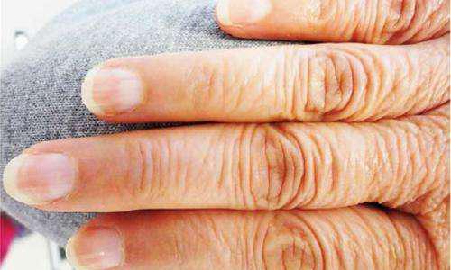 林赛氏指甲和普通指甲 林赛氏指甲是什么病