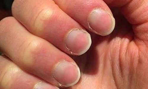 林赛氏指甲是什么 怎么鉴别是林赛氏指甲