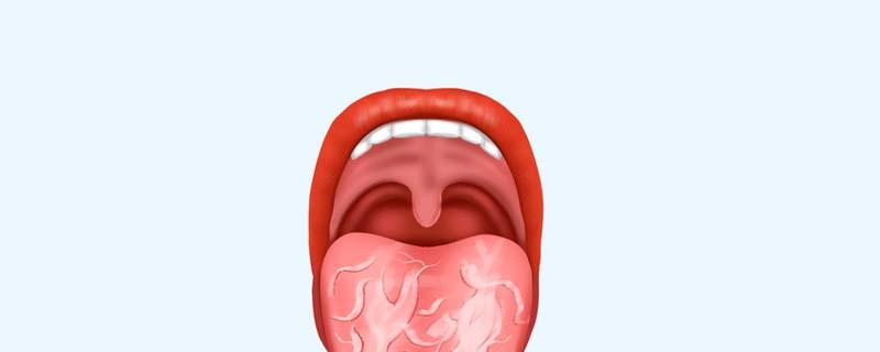 裂纹舌不能吃什么东西 裂纹舌有什么症状