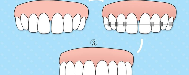 牙线圆线和扁线哪个好用 一根牙线可以清理多少颗牙
