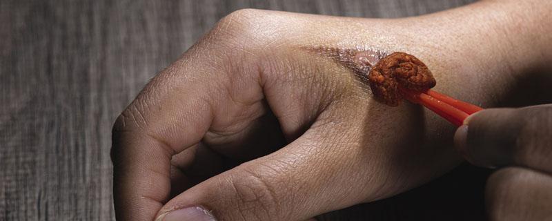 碘伏的作用与功效 碘伏能促进伤口愈合吗