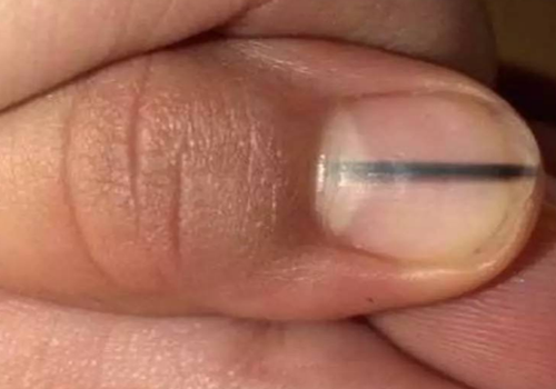 指甲上有黑线是癌症吗 哪种指甲黑线代表癌症