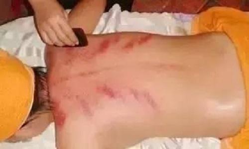 长痤疮刮痧什么部位 痤疮刮痧方法