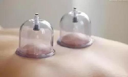 失眠拔罐在什么部位 失眠拔火罐哪个位置图