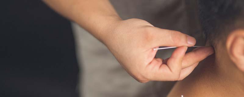 针灸完多久可以吹空调 夏天针灸后能吹风扇吗