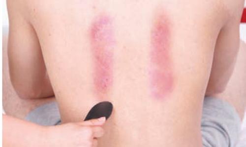 口腔溃疡刮痧部位是哪些 经常口腔溃疡是什么原因引起的