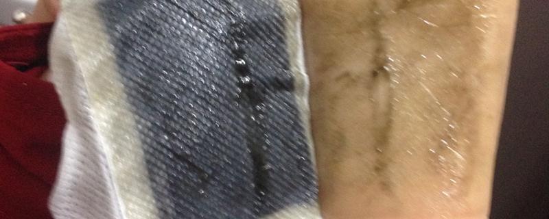足贴去湿气排出来的是汗还是湿气 足贴祛湿减肥是真的吗