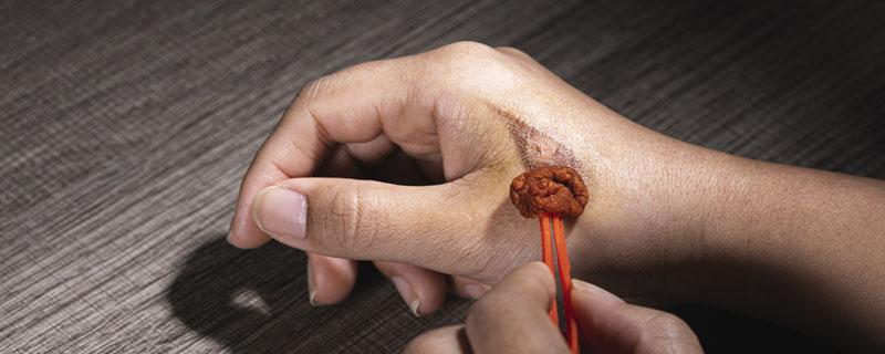 碘伏止痒吗 碘伏加洗发水可以去头屑吗