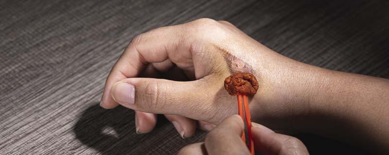 碘伏和酒精哪个对伤口愈合好 酒精消毒好还是碘伏消毒好