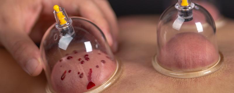拔血罐拔出的血凝成块是怎么回事 拔血罐的好处和坏处