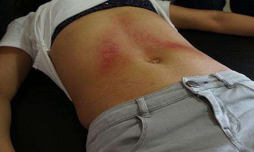 刮痧对痔疮有效果吗 痔疮刮痧刮哪里最好