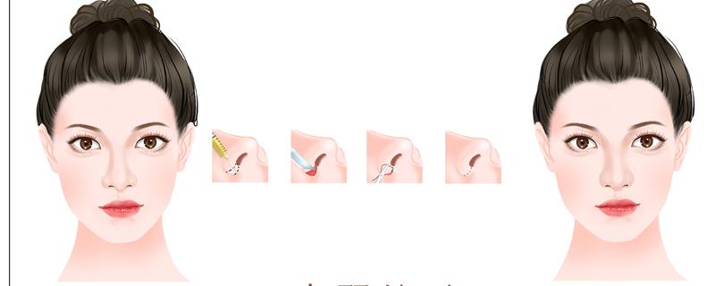 做鼻子后抽烟会怎么样 做鼻子多久可以化妆
