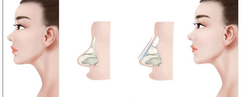 做鼻子发炎了怎么办 做鼻子感染症状有哪些