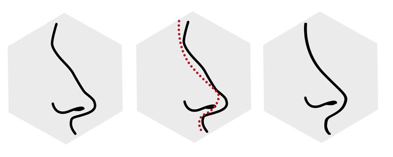 做鼻子玻尿酸好还是线雕好 做鼻子半个月可以喝酒吗